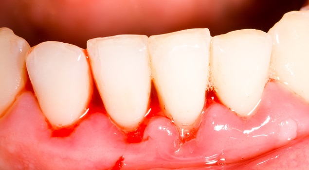 Gingivitis inflamación, hinchazón y sangrado de las encías